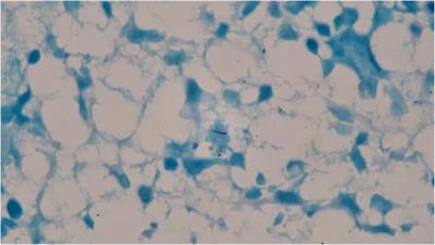 Pediatric isoniazid-resistant tuberculosis of the bone marrow manifesting as hemophagocytic syndrome: A case report